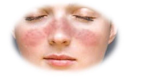 Lupus/sle Treatment in Pune