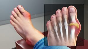 Gout Treatment in Pune