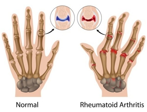 Rheumatoid Arthritis Treatment in Pune