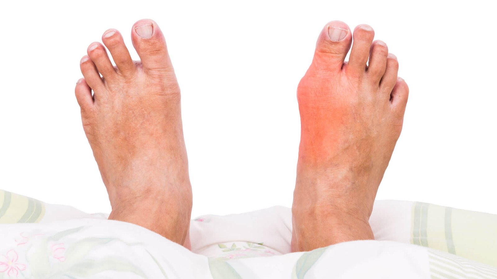 Gout Treatment in Pune